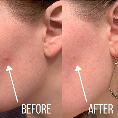 Skincosmetics Hydrocolloid Roll™