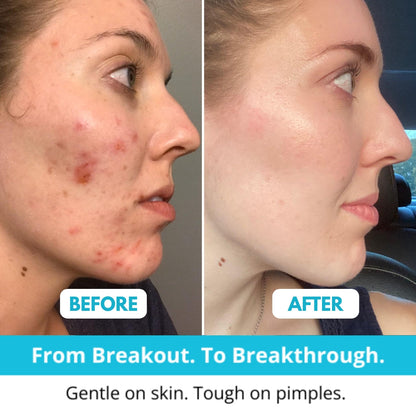 Skincosmetics Hydrocolloid Roll™