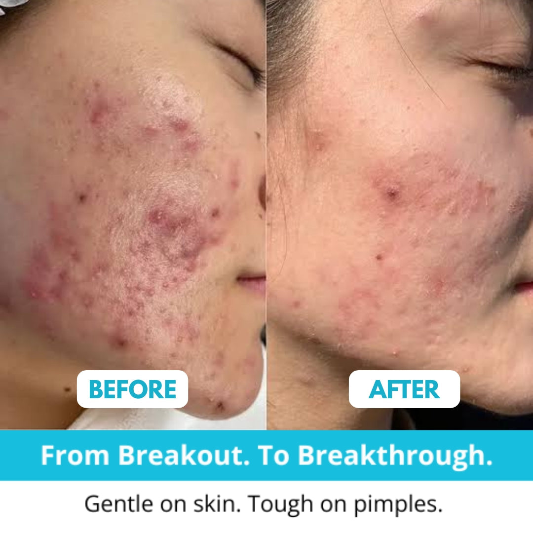 Skincosmetics Hydrocolloid Roll™