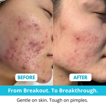 Skincosmetics Hydrocolloid Roll™