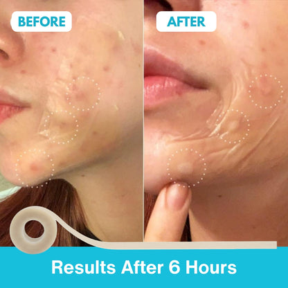 Skincosmetics Hydrocolloid Roll™
